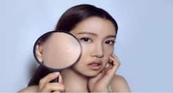 जानें क्या हैं चेहरे पर होने वाले डार्क स्पॉट्स के 5 मुख्य कारण ?