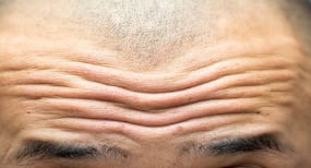 5 effective ways to erase forehead wrinkles