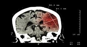 This new clot buster to transform ways of treating ischemic stroke in developing countries
