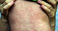 Bristol hit with widespread outbreak of Measles