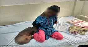 ओडिशा की रहने वाली एक लड़की ''प्लेक्सिफॉर्म न्यूरोफिब्रोमैटोसिस'' से है पीड़ित, क्या है यह दुर्लभ बीमारी, जानें