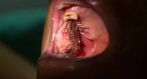 Can oral sex increase risk of mouth and throat cancers ...