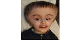 Gurgaon: 2-year-old from Tajikistan gets treated from a rare and complicated condition