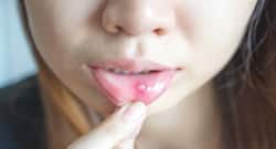 5 effective home remedies to treat canker sores