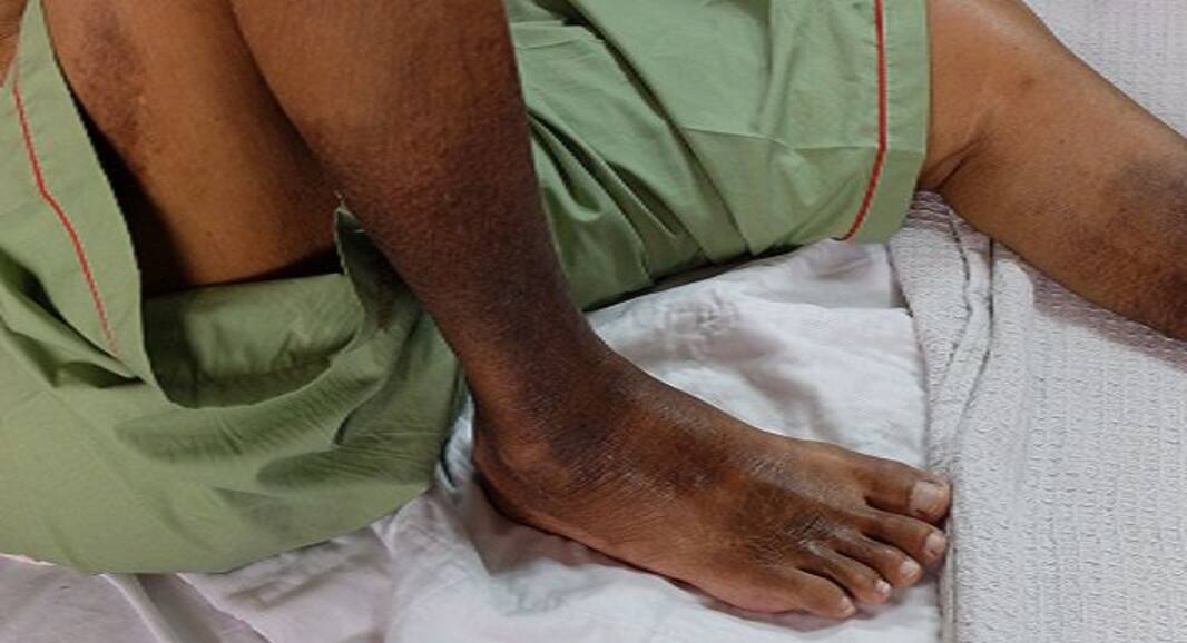 4 strange signs that may tell you have type 2 diabetes
