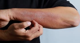 Bee venom may be effective in treating atopic eczema, finds study