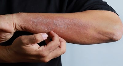 Study suggests way to treat severe eczema | TheHealthSite.com