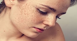 Here's how shea butter can help to get rid of freckles permanently