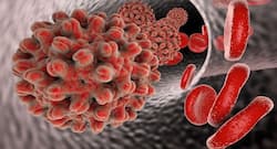 हेपेटाइटिस इंफेक्शन के दौरान क्या खाना चाहिए?