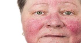 This skin condition might raise the risk of Alzheimer’s by 25 per cent