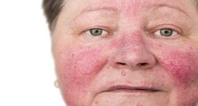 This skin condition might raise the risk of Alzheimer’s by 25 per cent