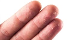 Hand skin peeling problem? Try these effective remedies at home