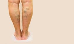 Varicose veins: 6 risk factors you must know about