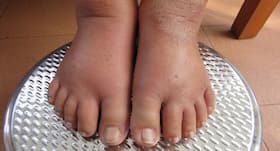 What are the causes of water retention? What are the causes of water retention?