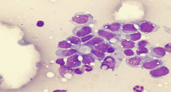 Some bone cancers in children grow without symptoms, finds study ...