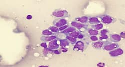 Some bone cancers in children grow without symptoms, finds study