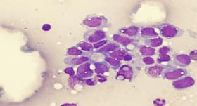Some bone cancers in children grow without symptoms, finds study
