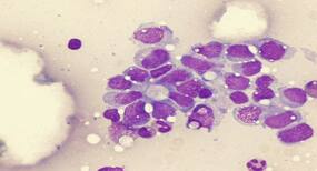 Some bone cancers in children grow without symptoms, finds study