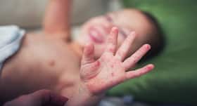 Now climate change can also cause hand, foot and mouth disease, shows study