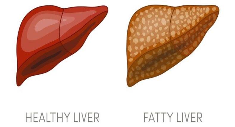 Gastroenterologist busts 5 myths about liver diseases