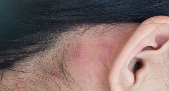 Here's how you can treat pimples behind the ears 