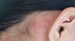 Here's how you can treat pimples behind the ears