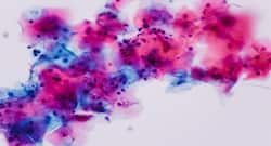 Everything you need to know about Candidiasis infection
