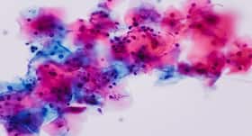 Everything you need to know about Candidiasis infection