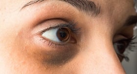 Home remedies that help you get rid of dark circles