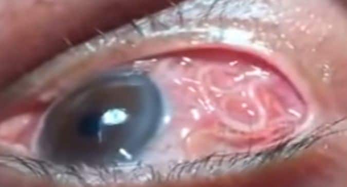 Bizarre! Doctor pulls out 15-cm-long worm from patient's eye