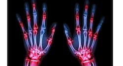 World Arthritis Day, October 12: Top 4 facts about rheumatoid arthritis that you should know