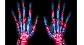 World Arthritis Day, October 12: Top 4 facts about rheumatoid arthritis that you should know