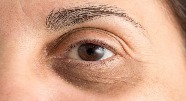 ऐसे घरेलू उपाय जो आसानी से दूर करेंगे आपके डार्क सर्कल्स
