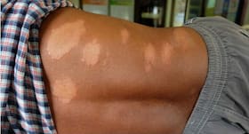 A look at leprosy in India: Watch out for these top symptoms to start treatment early on A look at leprosy in India: Watch out for these top symptoms to start treatment early on