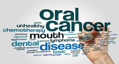 Expert speaks: All you need to know about oral cavity cancer ...