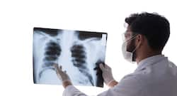 Facts about Pulmonary Coccidioidomycosis