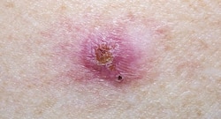 Know all about the nature's way of treating skin cancer