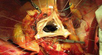 This Innovative Technology For Aortic Valve Surgery Saved Life Of A 33 