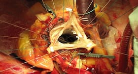 This innovative technology for aortic valve surgery saved life of a 33-year-old welder This innovative technology for aortic valve surgery saved life of a 33-year-old welder
