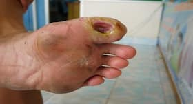 World Diabetes Day, November 14: Top 4 ways by which nature can save your diabetic foot