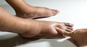 Healing diabetic foot ulcers the nature's way