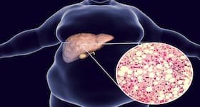 Unhealthy Lifestyle Can Lead To Liver Disease: Things To Avoid During The Lockdown To Protect Your Liver