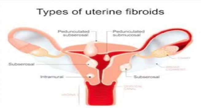 fibroids problem in women should be treated 1