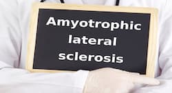Facts about amyotrophic lateral sclerosis