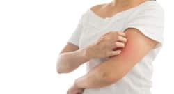 World Psoriasis Day, October 29: Home remedies to manage psoriasis symptoms