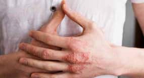 Anti-inflammatory drugs can prevent heart disease in psoriasis patients