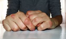 World Psoriasis Day: Psoriasis can put you at higher risk of these 5 conditions