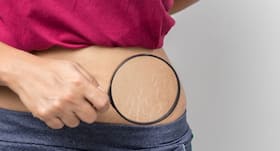 Everything you needed to know about stretch marks! Everything you needed to know about stretch marks!