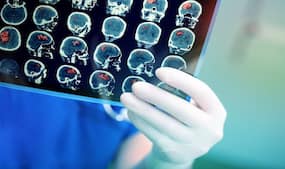 World Stroke Day: Diet tips for those who are recovering from a stroke attack