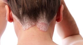 How Serious is Psoriasis